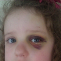 Alexis Hoskey was hit with a foul ball during a Royals game in 2011 | COURTESY OF MONTE HOSKEY 